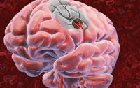 Опухоль головного мозга создает собственную сеть кровеносных сосудов 