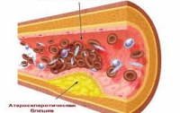 Ученые изобрели средство против атеросклероза