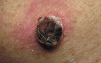 Медики: жара повышает риск заболевания раком кожи
