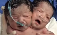 Двухголовый младенец родился в Мексике