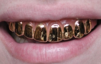 В Кузбассе арестовали золотые зубы