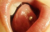 Пирсинг в языке разрушает зубы