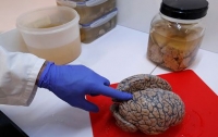 Вчені знайшли у мозку осередок людської свідомості