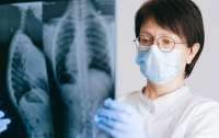 В МОЗ развеяли главные мифы о туберкулезе