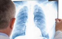 Ежегодно 4 тысячи украинцев умирают от туберкулеза