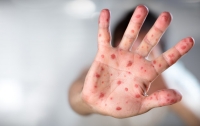Родители не сделали прививки: в Мукачево от кори умер ребенок