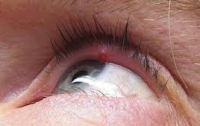 Ячмень: почему появляется и как лечить