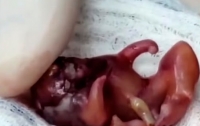 Женщина родила дочь с близнецом-паразитом внутри
