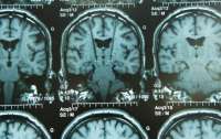 Вживление импланта в мозг вылечило у американки эпилепсию и ОКР
