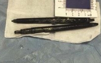 У китайца из живота достали две шариковые ручки, проглоченные 36 лет назад