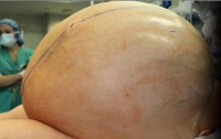 Врачи удалили женщине 60-килограммовую опухоль яичника