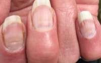 Після ковіду можуть змінитись нігті