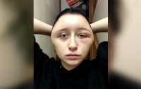 Из-за краски для волос у француженки деформировалось лицо