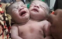 В Бангладеш родился ребенок с двумя головами