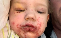 Невинный поцелуй изуродовал ребенка