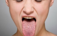 Медики рассказали, о каких болезнях говорит сухость во рту