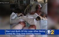 Мужчина лишился рук и ног из-за слюны собаки