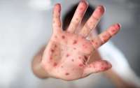 МОЗ бьет тревогу: в Украине зафиксирован рост случаев кори более чем в 20 раз