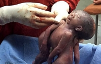 Жительница штата Гуджарат родила близнецов с одним лицом на двоих