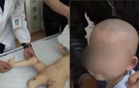 11-месячному мальчику успешно удалили третью ногу
