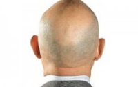 Лысеющим мужчинам стоит проверить здоровье сердца