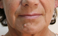 Старение кожи – наследственный фактор