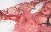 В Одесской области девочка умерла от ожогов из-за врача