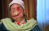 Разъяренная обезьяна оторвала 57-летней женщине веки, нос, губы и кисти рук