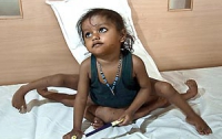 Девочке из Индии удалят лишние четыре конечности ее «близнеца-паразита» (ФОТО)