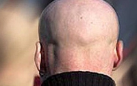 В чем кроется причина мужского облысения