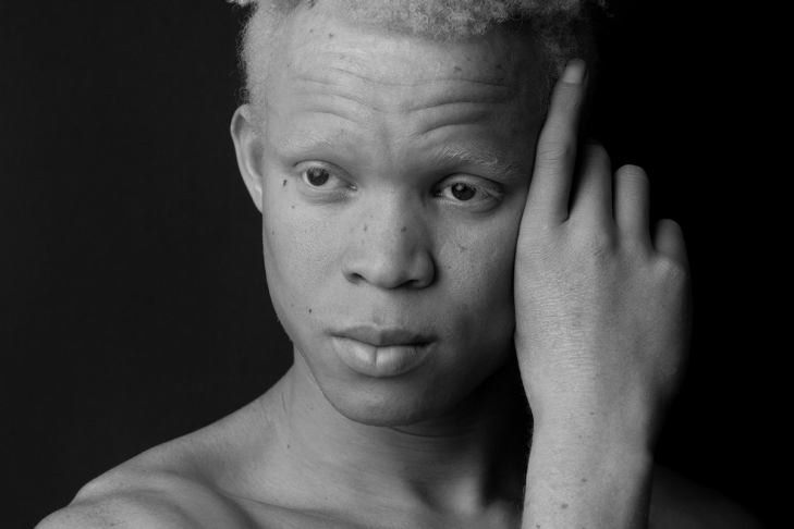 Белый негр. Афроамериканец альбинос. Нигер альбинос. Афроамериканец альбинос Лео.