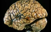 5 болезней, которые «убивают» ваш мозг