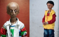 Из-за редчайшей болезни 15-летний индиец выглядит как старик