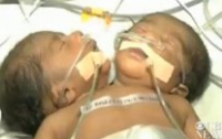 В Индии родился двуглавый мальчик