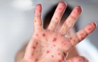 Корь в Украине: количество больных стремительно растет