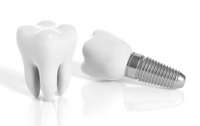 Имплантация зубов: как избежать осложнений и повысить приживаемость?