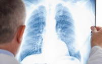 В МОЗ развенчали действенность массовой флюорографии