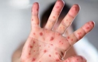 В Украине массовая вспышка кори еще в одном регионе: названа причина