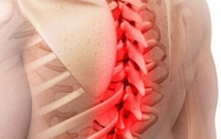 Как распознать грыжу позвоночника