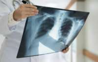 Растет заболеваемость туберкулезом: в 2023 году заболело 20 тыс. украинцев