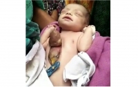 В Индии родилась девочка с сердцем наружу