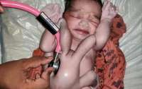 Ребенок с восемью конечностями родился в Индии