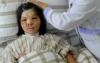 Китайские хирурги скроили девушке новое лицо из груди