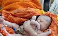 В Индии родился ребенок с четырьмя руками и ногами (фото)