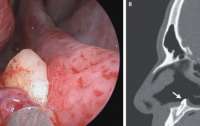 Мужчине удалили зуб, который вырос в носу