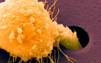 Ученые выяснили, как расползаются в организме раковые клетки
