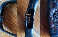 Женщина получила ожоги из-за взорвавшегося на руке браслета Fitbit